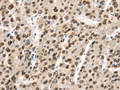 The image on the left is immunohistochemistry of paraffin-embedded Human liver cancer tissue using CSB-PA098304(TUSC5 Antibody) at dilution 1/40, on the right is treated with synthetic peptide. (Original magnification: ×200)