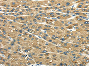 The image on the left is immunohistochemistry of paraffin-embedded Human liver cancer tissue using CSB-PA098316(UGT2B4 Antibody) at dilution 1/45, on the right is treated with fusion protein. (Original magnification: ×200)