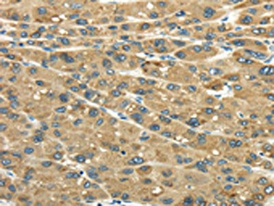 The image on the left is immunohistochemistry of paraffin-embedded Human liver cancer tissue using CSB-PA098316(UGT2B4 Antibody) at dilution 1/45, on the right is treated with fusion protein. (Original magnification: ×200)