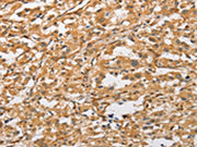 The image on the left is immunohistochemistry of paraffin-embedded Human thyroid cancer tissue using CSB-PA098497(ARMCX1 Antibody) at dilution 1/40, on the right is treated with fusion protein. (Original magnification: ×200)