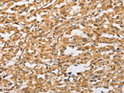 The image on the left is immunohistochemistry of paraffin-embedded Human thyroid cancer tissue using CSB-PA098497(ARMCX1 Antibody) at dilution 1/40, on the right is treated with fusion protein. (Original magnification: ×200)