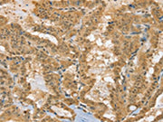 The image on the left is immunohistochemistry of paraffin-embedded Human thyroid cancer tissue using CSB-PA098589(PSMC1 Antibody) at dilution 1/40, on the right is treated with fusion protein. (Original magnification: ×200)