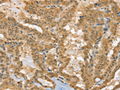 The image on the left is immunohistochemistry of paraffin-embedded Human thyroid cancer tissue using CSB-PA098589(PSMC1 Antibody) at dilution 1/40, on the right is treated with fusion protein. (Original magnification: ×200)
