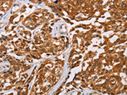 The image on the left is immunohistochemistry of paraffin-embedded Human esophagus cancer tissue using CSB-PA098689(CRYAB Antibody) at dilution 1/20, on the right is treated with fusion protein. (Original magnification: ×200)