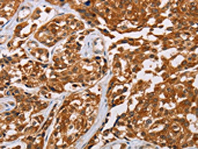 The image on the left is immunohistochemistry of paraffin-embedded Human esophagus cancer tissue using CSB-PA098689(CRYAB Antibody) at dilution 1/20, on the right is treated with fusion protein. (Original magnification: ×200)