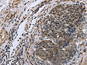 The image on the left is immunohistochemistry of paraffin-embedded Human cervical cancer tissue using CSB-PA098906(FANCG Antibody) at dilution 1/50, on the right is treated with fusion protein. (Original magnification: ×200)