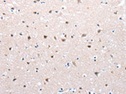 The image on the left is immunohistochemistry of paraffin-embedded Human brain cancer tissue using CSB-PA099030(FOXD2 Antibody) at dilution 1/25, on the right is treated with synthetic peptide. (Original magnification: ×200)