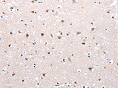 The image on the left is immunohistochemistry of paraffin-embedded Human brain cancer tissue using CSB-PA099030(FOXD2 Antibody) at dilution 1/25, on the right is treated with synthetic peptide. (Original magnification: ×200)