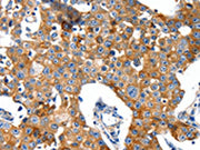 The image on the left is immunohistochemistry of paraffin-embedded Human breast cancer tissue using CSB-PA099037(GRIA2 Antibody) at dilution 1/40, on the right is treated with synthetic peptide. (Original magnification: ×200)