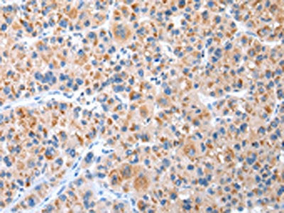 The image on the left is immunohistochemistry of paraffin-embedded Human liver cancer tissue using CSB-PA099227(CXCR4 Antibody) at dilution 1/20, on the right is treated with synthetic peptide. (Original magnification: ×200)