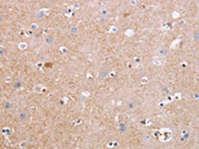 The image on the left is immunohistochemistry of paraffin-embedded Human brain tissue using CSB-PA099386(CDC7 Antibody) at dilution 1/50, on the right is treated with synthetic peptide. (Original magnification: ×200)