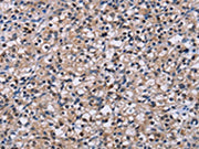 The image on the left is immunohistochemistry of paraffin-embedded Human prostate cancer tissue using CSB-PA099477(NR1D1 Antibody) at dilution 1/60, on the right is treated with fusion protein. (Original magnification: ×200)