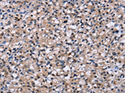 The image on the left is immunohistochemistry of paraffin-embedded Human prostate cancer tissue using CSB-PA099477(NR1D1 Antibody) at dilution 1/60, on the right is treated with fusion protein. (Original magnification: ×200)