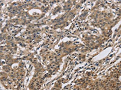 The image on the left is immunohistochemistry of paraffin-embedded Human gastic cancer tissue using CSB-PA099615(DHRS3 Antibody) at dilution 1/30, on the right is treated with fusion protein. (Original magnification: ×200)