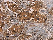 The image on the left is immunohistochemistry of paraffin-embedded Human breast cancer tissue using CSB-PA099632(KIF20A Antibody) at dilution 1/25, on the right is treated with fusion protein. (Original magnification: ×200)