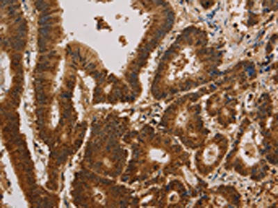 The image on the left is immunohistochemistry of paraffin-embedded Human colon cancer tissue using CSB-PA099774(CSNK2B Antibody) at dilution 1/30, on the right is treated with synthetic peptide. (Original magnification: ×200)