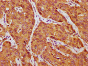 IHC image of CSB-PA09987A0Rb diluted at 1:750 and staining in paraffin-embedded human liver cancer performed on a Leica BondTM system. After dewaxing and hydration, antigen retrieval was mediated by high pressure in a citrate buffer (pH 6.0). Sect...
