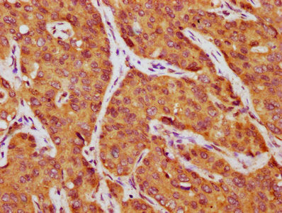 IHC image of CSB-PA09987A0Rb diluted at 1:750 and staining in paraffin-embedded human liver cancer performed on a Leica BondTM system. After dewaxing and hydration, antigen retrieval was mediated by high pressure in a citrate buffer (pH 6.0). Sect...