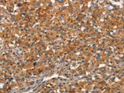 The image on the left is immunohistochemistry of paraffin-embedded Human thyroid cancer tissue using CSB-PA099883(ARPC2 Antibody) at dilution 1/30, on the right is treated with synthetic peptide. (Original magnification: ×200)