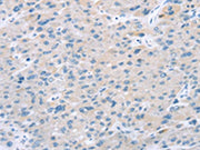 The image on the left is immunohistochemistry of paraffin-embedded Human liver cancer tissue using CSB-PA099944(EI24 Antibody) at dilution 1/25, on the right is treated with synthetic peptide. (Original magnification: ×200)