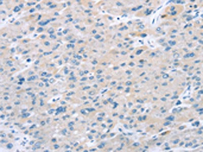 The image on the left is immunohistochemistry of paraffin-embedded Human liver cancer tissue using CSB-PA099944(EI24 Antibody) at dilution 1/25, on the right is treated with synthetic peptide. (Original magnification: ×200)