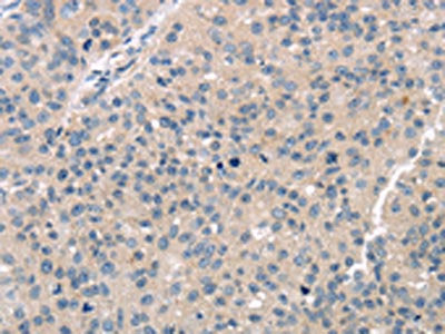 The image on the left is immunohistochemistry of paraffin-embedded Human breast cancer tissue using CSB-PA100188(TTC23 Antibody) at dilution 1/30, on the right is treated with fusion protein. (Original magnification: ×200)