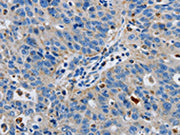 The image on the left is immunohistochemistry of paraffin-embedded Human ovarian cancer tissue using CSB-PA100222(GRIA3 Antibody) at dilution 1/50, on the right is treated with synthetic peptide. (Original magnification: ×200)