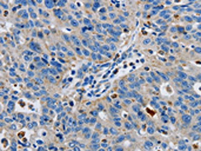 The image on the left is immunohistochemistry of paraffin-embedded Human ovarian cancer tissue using CSB-PA100222(GRIA3 Antibody) at dilution 1/50, on the right is treated with synthetic peptide. (Original magnification: ×200)