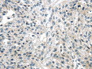 The image on the left is immunohistochemistry of paraffin-embedded Human breast cancer tissue using CSB-PA100309(ULBP1 Antibody) at dilution 1/25, on the right is treated with synthetic peptide. (Original magnification: ×200)