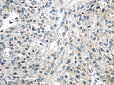The image on the left is immunohistochemistry of paraffin-embedded Human breast cancer tissue using CSB-PA100309(ULBP1 Antibody) at dilution 1/25, on the right is treated with synthetic peptide. (Original magnification: ×200)