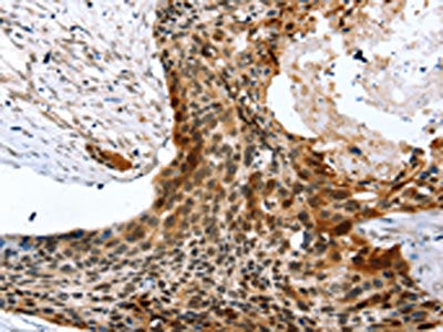 The image on the left is immunohistochemistry of paraffin-embedded Human esophagus cancer tissue using CSB-PA100389(SYNPO2 Antibody) at dilution 1/45, on the right is treated with synthetic peptide. (Original magnification: ×200)