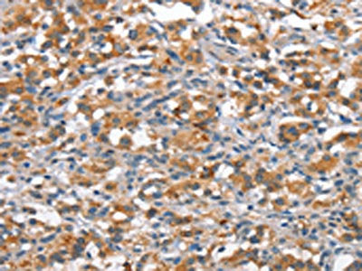 The image on the left is immunohistochemistry of paraffin-embedded Human thyroid cancer tissue using CSB-PA100422(ANP32C Antibody) at dilution 1/15, on the right is treated with synthetic peptide. (Original magnification: ×200)