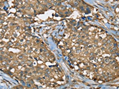 The image on the left is immunohistochemistry of paraffin-embedded Human breast cancer tissue using CSB-PA100535(SEZ6L Antibody) at dilution 1/35, on the right is treated with synthetic peptide. (Original magnification: ×200)