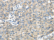 The image on the left is immunohistochemistry of paraffin-embedded Human breast cancer tissue using CSB-PA100573(UGP2 Antibody) at dilution 1/35, on the right is treated with fusion protein. (Original magnification: ×200)
