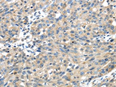 The image on the left is immunohistochemistry of paraffin-embedded Human breast cancer tissue using CSB-PA100573(UGP2 Antibody) at dilution 1/35, on the right is treated with fusion protein. (Original magnification: ×200)