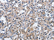 The image on the left is immunohistochemistry of paraffin-embedded Human thyroid cancer tissue using CSB-PA100599(CD244 Antibody) at dilution 1/40, on the right is treated with fusion protein. (Original magnification: ×200)