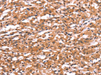 The image on the left is immunohistochemistry of paraffin-embedded Human thyroid cancer tissue using CSB-PA100614(GABRA1 Antibody) at dilution 1/30, on the right is treated with synthetic peptide. (Original magnification: ×200)