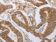 The image on the left is immunohistochemistry of paraffin-embedded Human colon cancer tissue using CSB-PA100644(NEUROG1 Antibody) at dilution 1/25, on the right is treated with synthetic peptide. (Original magnification: ×200)