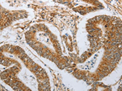 The image on the left is immunohistochemistry of paraffin-embedded Human colon cancer tissue using CSB-PA100644(NEUROG1 Antibody) at dilution 1/25, on the right is treated with synthetic peptide. (Original magnification: ×200)