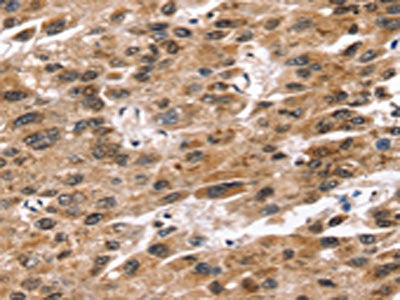 The image on the left is immunohistochemistry of paraffin-embedded Human liver cancer tissue using CSB-PA100755(SNTA1 Antibody) at dilution 1/20, on the right is treated with synthetic peptide. (Original magnification: ×200)
