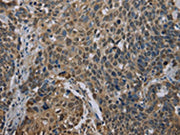 The image on the left is immunohistochemistry of paraffin-embedded Human cervical cancer tissue using CSB-PA100810(UBP1 Antibody) at dilution 1/40, on the right is treated with synthetic peptide. (Original magnification: ×200)