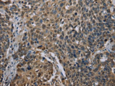 The image on the left is immunohistochemistry of paraffin-embedded Human cervical cancer tissue using CSB-PA100810(UBP1 Antibody) at dilution 1/40, on the right is treated with synthetic peptide. (Original magnification: ×200)