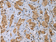 The image on the left is immunohistochemistry of paraffin-embedded Human breast cancer tissue using CSB-PA100844(CLEC1A Antibody) at dilution 1/40, on the right is treated with fusion protein. (Original magnification: ×200)
