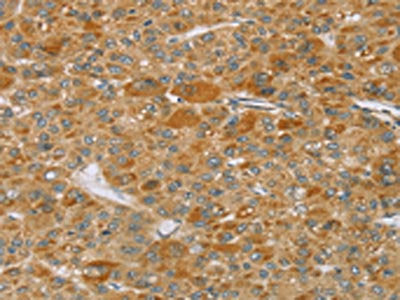 The image on the left is immunohistochemistry of paraffin-embedded Human liver cancer tissue using CSB-PA100892(TP53I11 Antibody) at dilution 1/40, on the right is treated with synthetic peptide. (Original magnification: ×200)