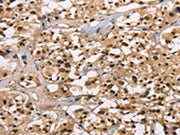 The image on the left is immunohistochemistry of paraffin-embedded Human thyroid cancer tissue using CSB-PA101001(CARD8 Antibody) at dilution 1/30, on the right is treated with fusion protein. (Original magnification: ×200)