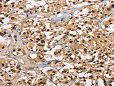 The image on the left is immunohistochemistry of paraffin-embedded Human thyroid cancer tissue using CSB-PA101001(CARD8 Antibody) at dilution 1/30, on the right is treated with fusion protein. (Original magnification: ×200)