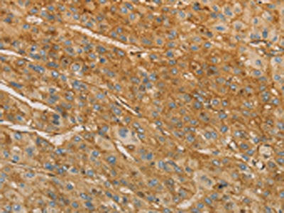 The image on the left is immunohistochemistry of paraffin-embedded Human liver cancer tissue using CSB-PA101139(VTN Antibody) at dilution 1/40, on the right is treated with fusion protein. (Original magnification: ×200)