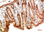 Immunohistochemical analysis of paraffin-embedded Human Colon Carcinoma Tissue using MEK2 Rabbit pAb diluted at 1:200