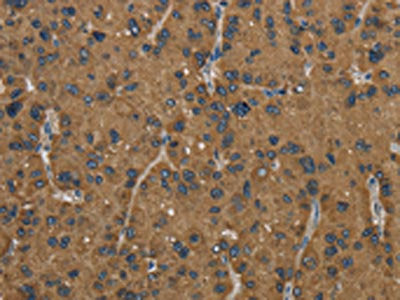 The image on the left is immunohistochemistry of paraffin-embedded Human liver cancer tissue using CSB-PA101238(HSD17B2 Antibody) at dilution 1/50, on the right is treated with fusion protein. (Original magnification: ×200)