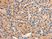 The image on the left is immunohistochemistry of paraffin-embedded Human liver cancer tissue using CSB-PA101358(DOCK1 Antibody) at dilution 1/25, on the right is treated with synthetic peptide. (Original magnification: ×200)